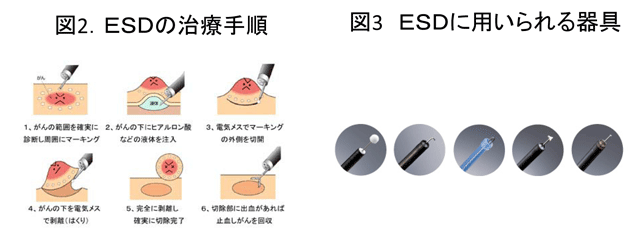 図2 ESDの治療手順・図3 ESDに用いられる器具