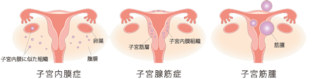 対象疾患と手術の図