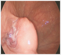 胃カメラで見つかった胃粘膜下腫瘍