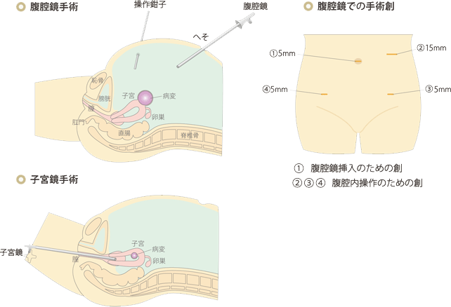 腹腔鏡手術