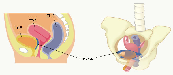 膣前方TVM（膀胱瘤）図
