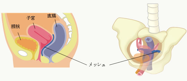 膣後方TVM（子宮脱・直腸瘤）図