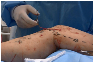 スタブ・アバルジョン法−最小の傷による手術
